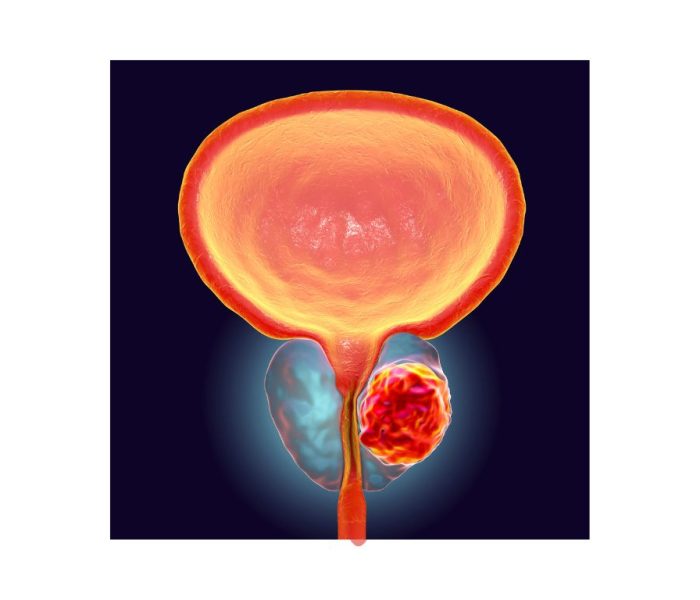 Cancer de prostata